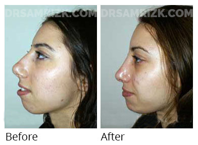 Woman's face, before and after Chin and cheek treatment, side view, patient 2