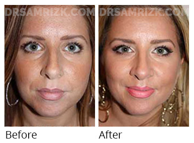 Woman's face, before and after Chin and cheek treatment, front view, patient 4