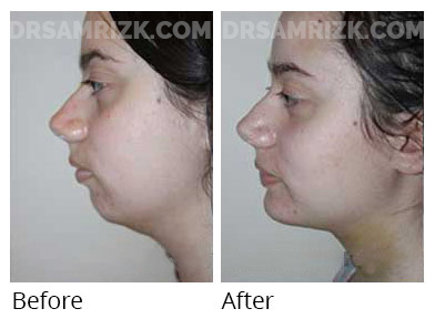Woman's face, before and after Chin and cheek treatment, side view, patient 6