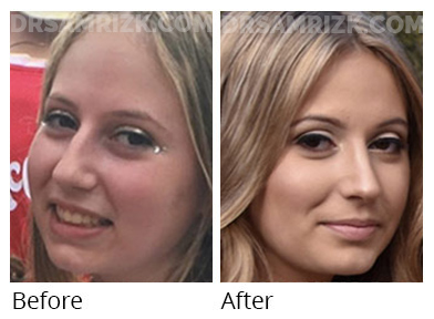 Woman's face, before and after Chin and cheek treatment, front view, patient 8