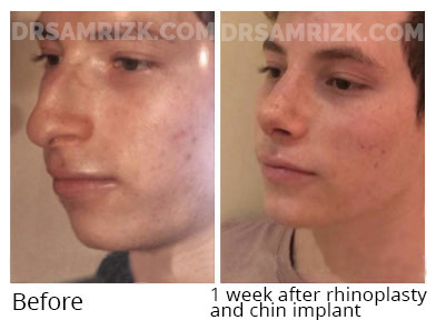 Men face, before and after Chin and cheek treatment, front view, patient 10