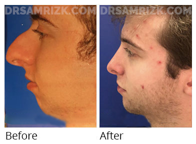 Man's face, before and after Chin and cheek treatment, front view, patient 11