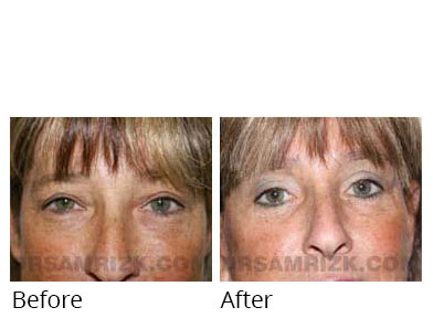 Female face, before and after Eyelids surgery, front view, patient 1