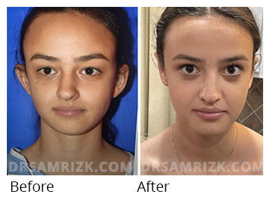 15 years old female patient head, before and after otoplasty treatment, front view (patient 2)