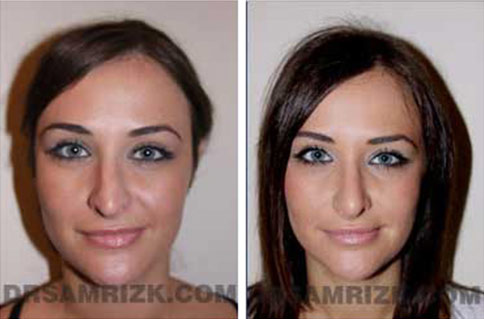 Woman's face, before and after Revision Rhinoplasty treatment, front view