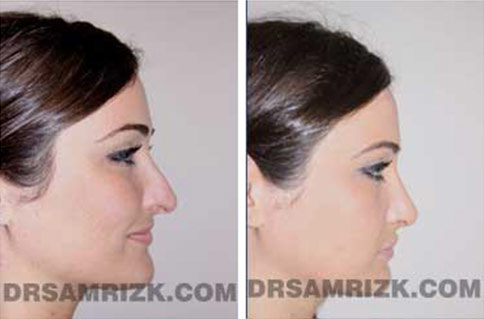 Woman's face, before and after Revision Rhinoplasty treatment, l-side view