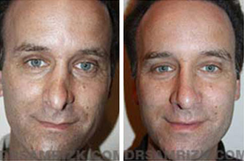 Man's face, before and after Revision Rhinoplasty treatment, l-Front view