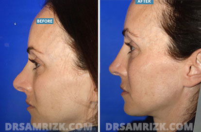 Woman face, before and after Revision Rhinoplasty treatment, l-side view