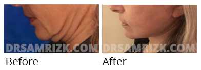 Female face, before and after Facelift, oblique view, patient 49