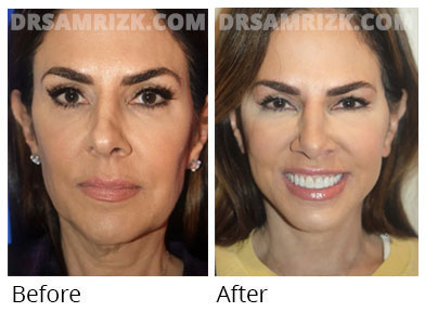 Female face, before and after Facelift, front view, patient 48