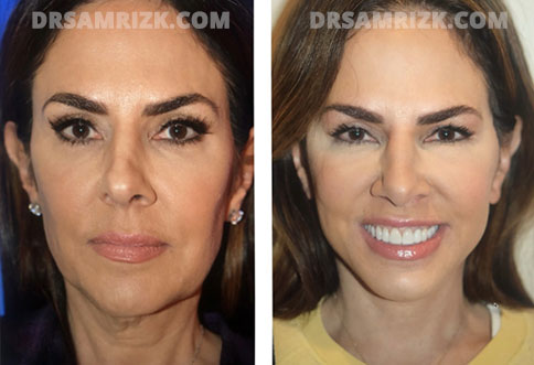 Jennifer Fessler face, before and after Facelift Surgery, front view