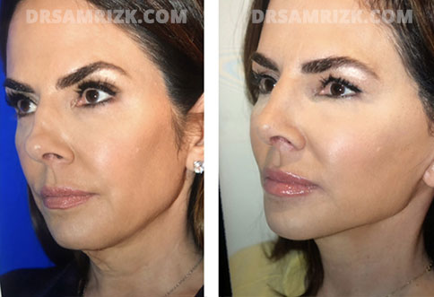 Jennifer Fessler face, before and after Facelift Surgery, l-side oblique view