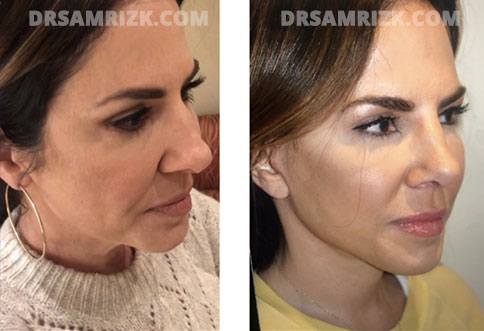 Jennifer Fessler face, before and after Facelift Surgery, r-side oblique view