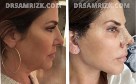 Patient 11 Set1 before and after nose surgery