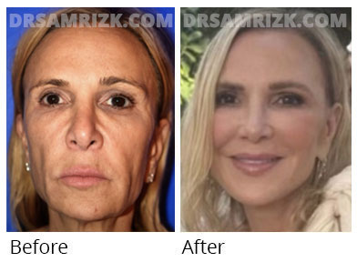 Female face, before and after Facelift, front view, patient 50