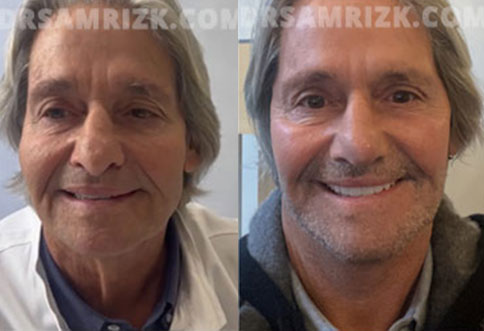 Before and After Facelift Surgery