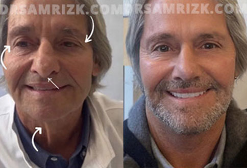 photos male patient  Before and After Facelift