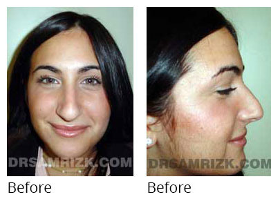 Female face, before and after Rhinoplasty treatment, front view, patient 9