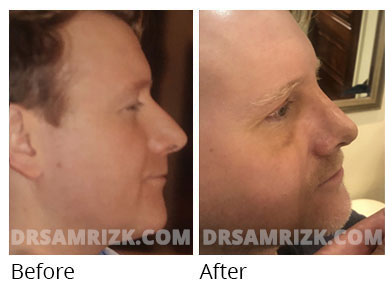 Male face, before and after Rhinoplasty treatment, oblique view, patient 39