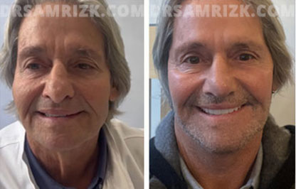 Patient 12 Set1 before and after facelift surgery