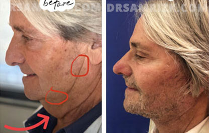Patient 11 Set1 before and after facelift surgery
