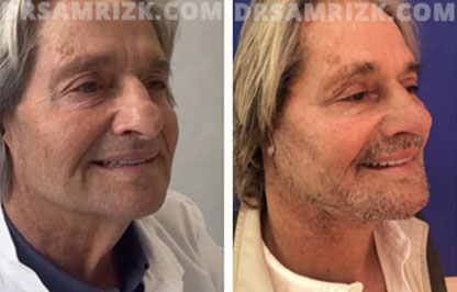 Patient 11 Set1 before and after facelift surgery