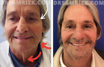 Patient 12 Set1 before and after facelift surgery