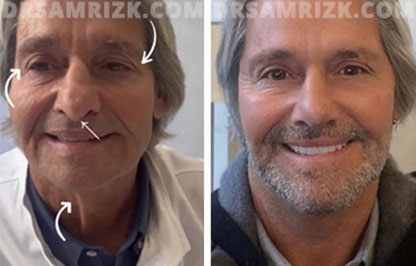 Patient 12 Set1 before and after facelift surgery