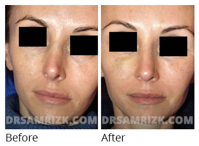 Female face, before and after Rhinoplasty treatment, front view, patient 57