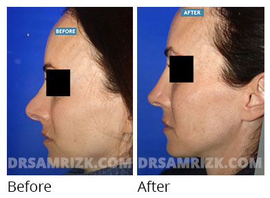 Female face, before and after Rhinoplasty treatment, front view, patient 57