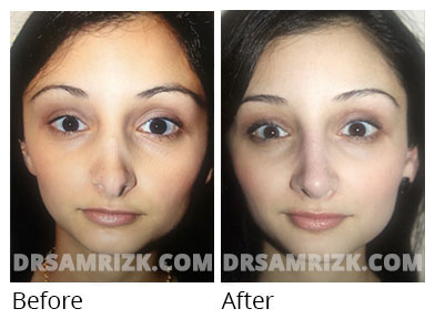 Female face, before and after Rhinoplasty treatment, front view, patient 58