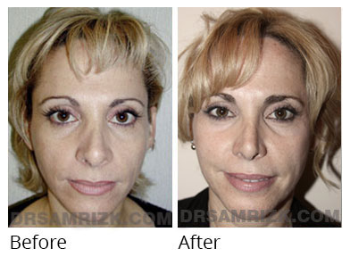 Female face, before and after Rhinoplasty treatment, front view, patient 59