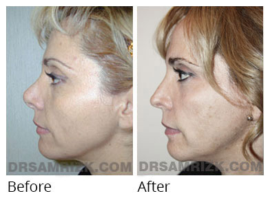 Female face, before and after Rhinoplasty treatment, front view, patient 59