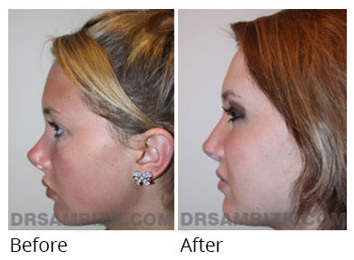 Female face, before and after Rhinoplasty treatment, front view, patient 60