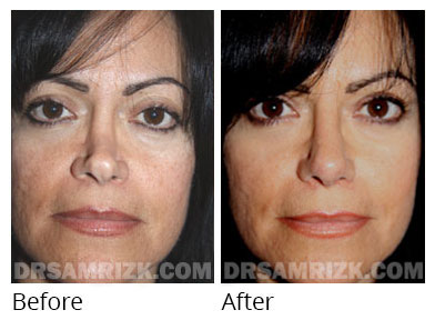 Female face, before and after Rhinoplasty treatment, front view, patient 61