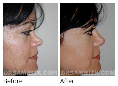 Female face, before and after Rhinoplasty treatment, front view, patient 61