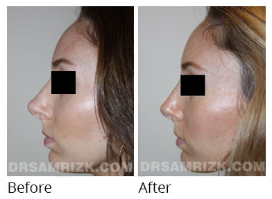 Female face, before and after Rhinoplasty treatment, front view, patient 62