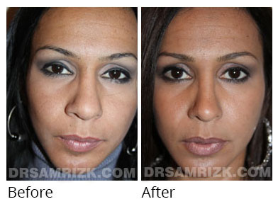 Female face, before and after Rhinoplasty treatment, front view, patient 63