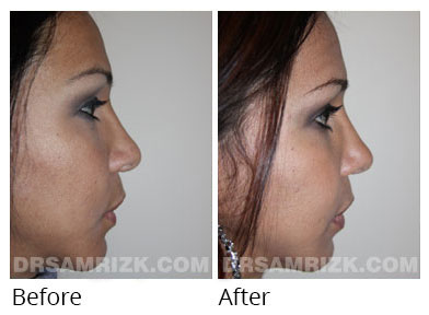 Female face, before and after Rhinoplasty treatment, front view, patient 63