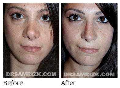 Female face, before and after Rhinoplasty treatment, front view, patient 64