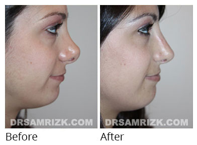 Female face, before and after Rhinoplasty treatment, front view, patient 64
