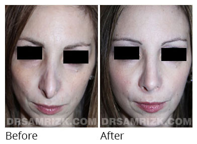 Female face, before and after Rhinoplasty treatment, front view, patient 65