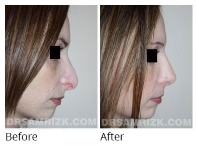 Female face, before and after Rhinoplasty treatment, front view, patient 65