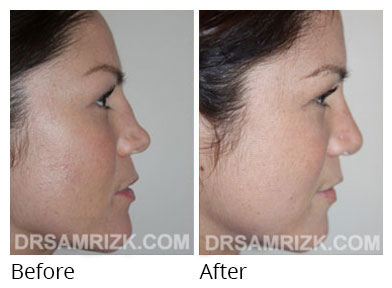 Female face, before and after Rhinoplasty treatment, front view, patient 66