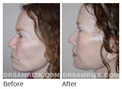 Female face, before and after Rhinoplasty treatment, front view, patient 67