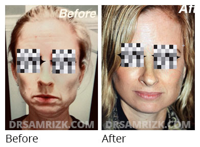 Female face, before and after Facelift and necklift treatment, front view, patient 13