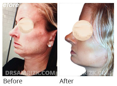 Female face, before and after Facelift and necklift treatment, side view, patient 13