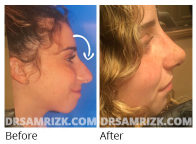 Female face, before and after Rhinoplasty treatment, front view, patient 68