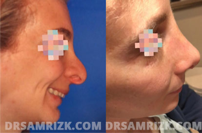 Woman face, before and after Rhinoplasty treatment