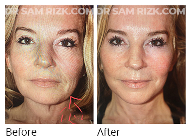 Female face, before and after Facelift and necklift treatment, front view, patient 46